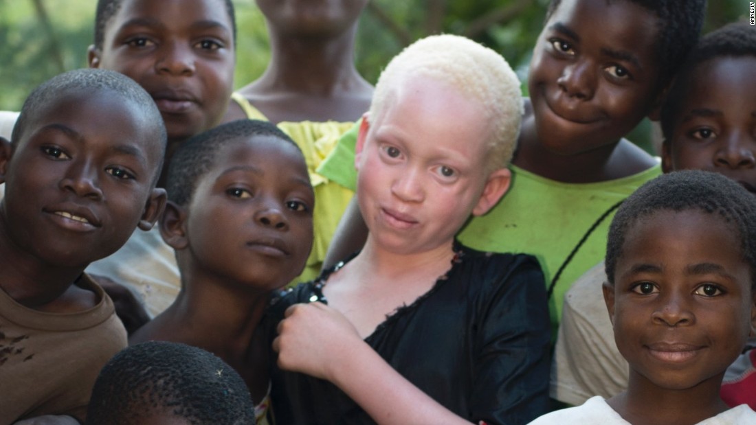 People With Albinism